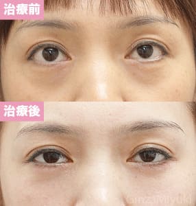 モニター症例№122（43歳 女性）脱脂コンデンスリポ