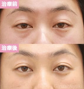 モニター症例№124（31歳 男性）脱脂コンデンスリポ