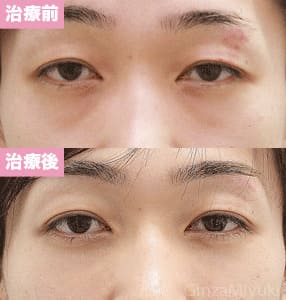 モニター症例№125（29歳 男性）脱脂コンデンスリポ