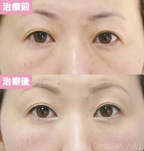 モニター症例№126（39歳 女性）脱脂ダブルリポ