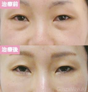 モニター症例№127（33歳 女性）脱脂ダブルリポ