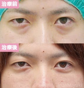 モニター症例№128（24歳 男性）脱脂ダブルリポ