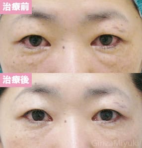 モニター症例№129（40歳 女性）脱脂リポ法