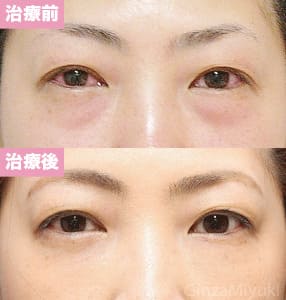 モニター症例№130（36歳 女性）脱脂ダブルリポ