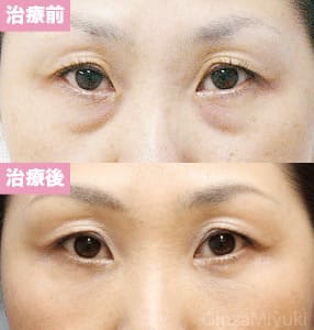 モニター症例№131（46歳 女性）脱脂ダブルリポ