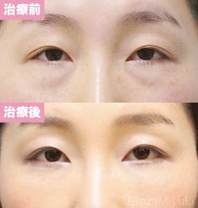 モニター症例№132（41歳 女性）脱脂ダブルリポ