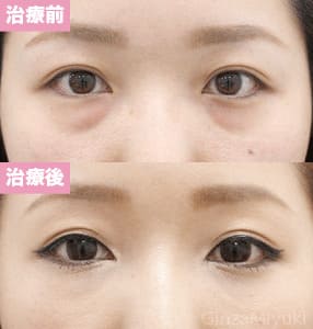 モニター症例№133（28歳 女性）脱脂コンデンスリポ