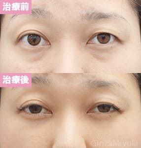 モニター症例№134（30歳 女性）脱脂コンデンスリポ