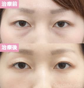 モニター症例№135（24歳 女性）脱脂コンデンスリポ