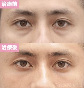 モニター症例№136（33歳 男性）脱脂コンデンスリポ