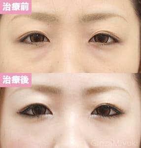 モニター症例№137（30歳 女性）脱脂ダブルリポ