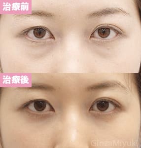 モニター症例№138（29歳 女性）脱脂コンデンスリポ