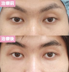 モニター症例№139（30歳 男性）脱脂コンデンスリポ