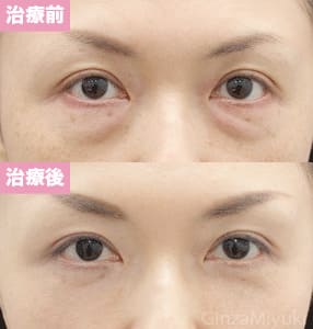 モニター症例№140（41歳 女性）脱脂コンデンスリポ