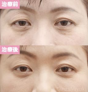 モニター症例№141（48歳 女性）脱脂コンデンスリポ