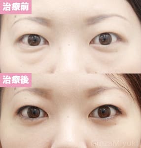 モニター症例№142（30歳 女性）脱脂ダブルリポ