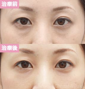 モニター症例№143（39歳 女性）脱脂コンデンスリポ