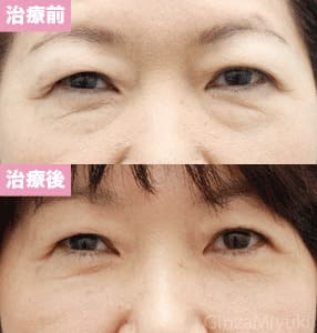 モニター症例№144（58歳 女性）脱脂コンデンスリポ