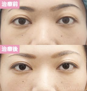 モニター症例№145（30歳 女性）コンデンスリポ法