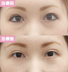 モニター症例№146（28歳 女性）脱脂ダブルリポ