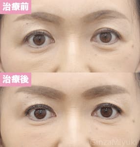 モニター症例№148（48歳 女性）コンデンスリポ法