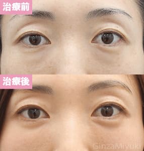 モニター症例№150（37歳 女性）脱脂ダブルリポ