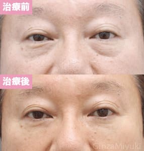 モニター症例№152（56歳 男性）脱脂コンデンスリポ