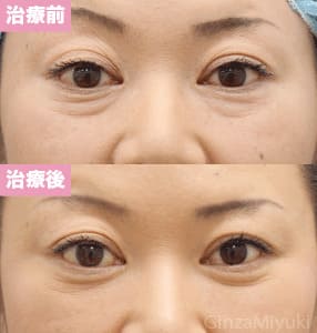 モニター症例№153（45歳 女性）脱脂ダブルリポ