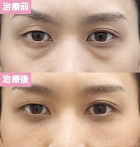 モニター症例№154（33歳 女性）脱脂コンデンスリポ