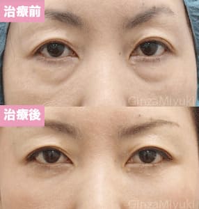 モニター症例№155（46歳 女性）脱脂コンデンスリポ