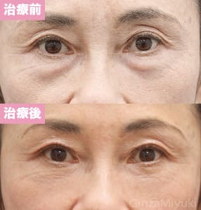 モニター症例№156（55歳 女性）脱脂コンデンスリポ