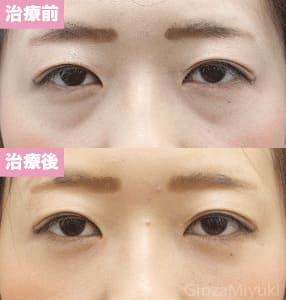 モニター症例№157（25歳 女性）脱脂ダブルリポ