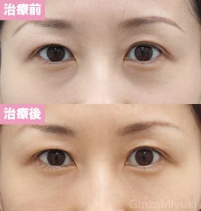 モニター症例№158（32歳 女性）脱脂ダブルリポ