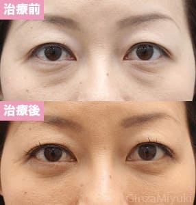 モニター症例№159（35歳 女性）脱脂コンデンスリポ