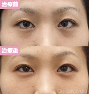 モニター症例№161（35歳 女性）コンデンスリポ法