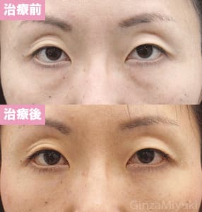 モニター症例№162（35歳 女性）脱脂コンデンスリポ