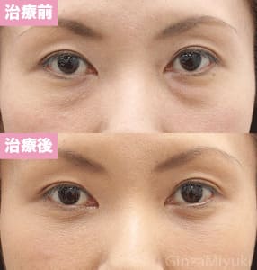 モニター症例№164（42歳 女性）脱脂コンデンスリポ