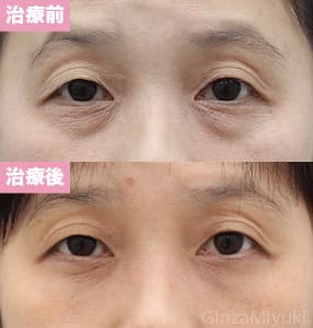 モニター症例№165（43歳 女性）脱脂コンデンスリポ