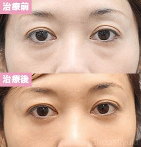 モニター症例№166（43歳 女性）脱脂コンデンスリポ