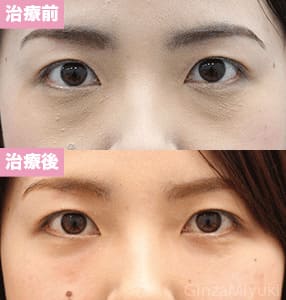 モニター症例№168（27歳 女性）脱脂コンデンスリポ