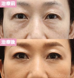 モニター症例№169（50歳 女性）脱脂ダブルリポ