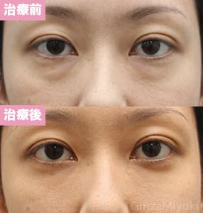 モニター症例№170（38歳 女性）脱脂コンデンスリポ