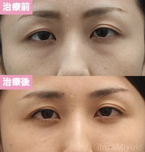 モニター症例№172（33歳 女性）脱脂コンデンスリポ