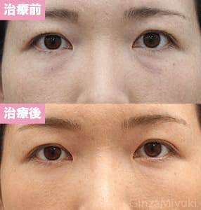 モニター症例№173（33歳 女性）脱脂コンデンスリポ