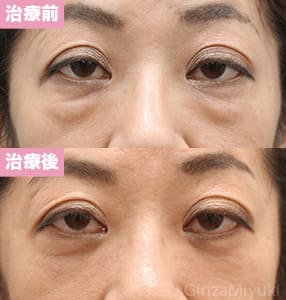 モニター症例№174（51歳 女性）脱脂コンデンスリポ