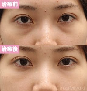 モニター症例№175（27歳 女性）脱脂コンデンスリポ