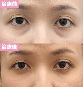 モニター症例№176（39歳 女性）脱脂コンデンスリポ