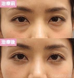 モニター症例№177（36歳 女性）脱脂コンデンスリポ