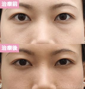 モニター症例№178（31歳 女性）脱脂コンデンスリポ