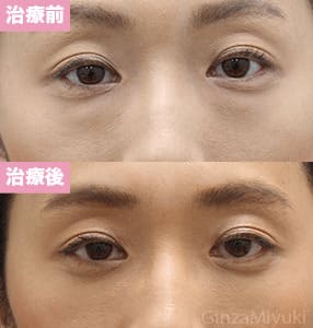 モニター症例№179（39歳 女性）脱脂コンデンスリポ